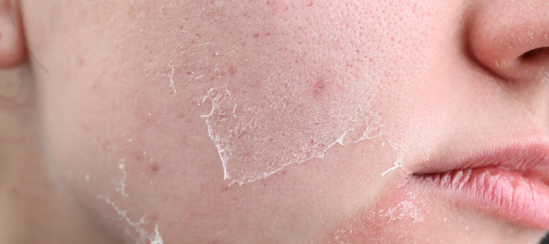 How to Moisturize and Cleanse Your Skin to Prevent Rough Skin: Causes and Skincare Tips